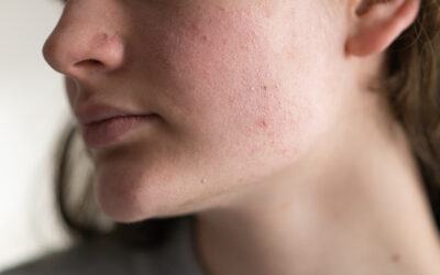 Preventing CPAP Mask Skin Irritation